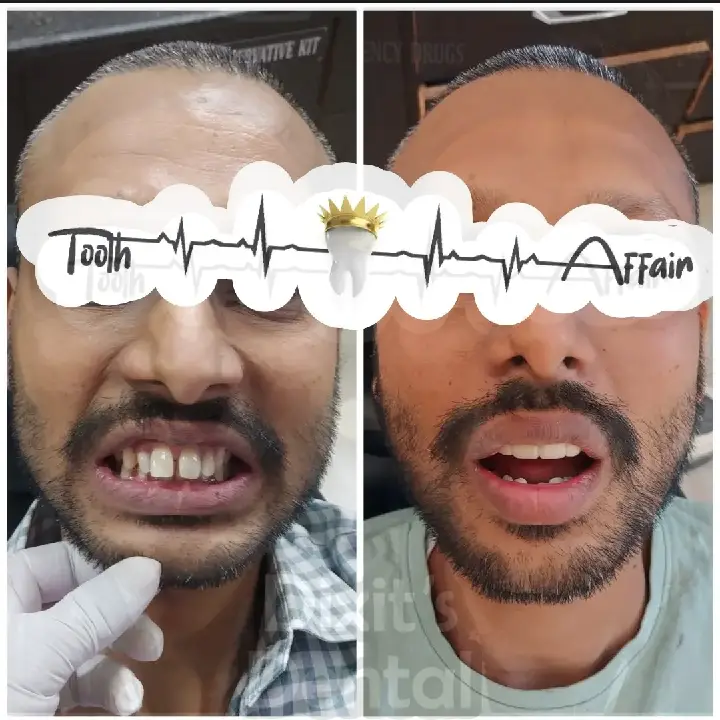 Before and after